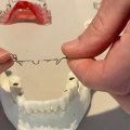 Why Orthodontists Don't Pull Teeth Anymore