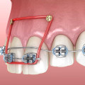 Why Orthodontists are the Best Choice for Your Oral Health