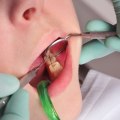 Do Dentists or Orthodontists Fix Cavities?