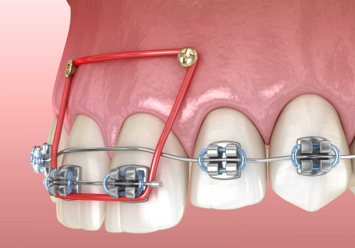 Why Orthodontists are the Best Choice for Your Oral Health