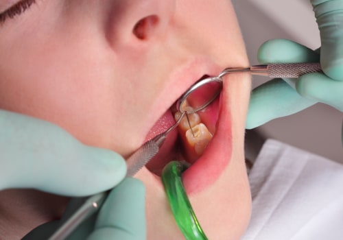Do Dentists or Orthodontists Fix Cavities?